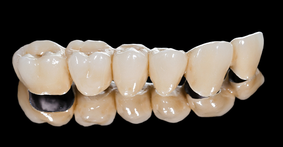 Restore Your Smile & Bite: Everything You Need to Know About Dental Bridges in Houston, TX