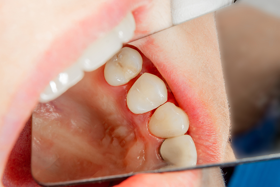 Protecting Your Smile: The Benefits of Dental Sealants in Houston, TX