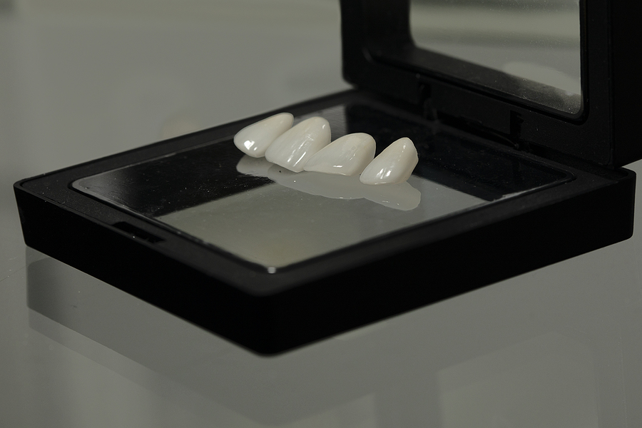 Transform Your Smile with Porcelain Veneers in Houston, TX: A Complete Guide to a Radiant Smile