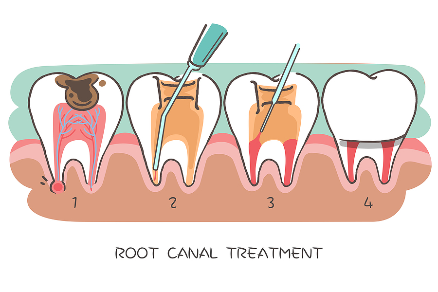 Everything You Need to Know About Root Canal Treatment in Houston, TX: A Complete Guide