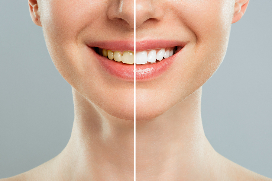 Brighten Your Smile: Everything You Need to Know About Teeth Whitening in Houston, TX